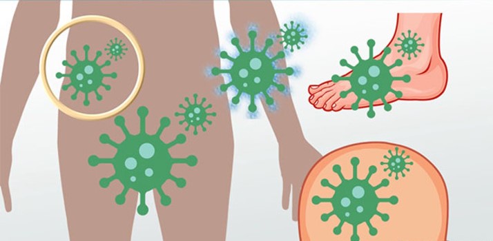 Όλα Όσα Πρέπει να Γνωρίζετε για τις Επιφανειακές Μυκητιάσεις και την Αντιμετώπισή τους. Όλα Όσα Πρέπει να Γνωρίζετε για τις Επιφανειακές Μυκητιάσεις και την Αντιμετώπισή τους.