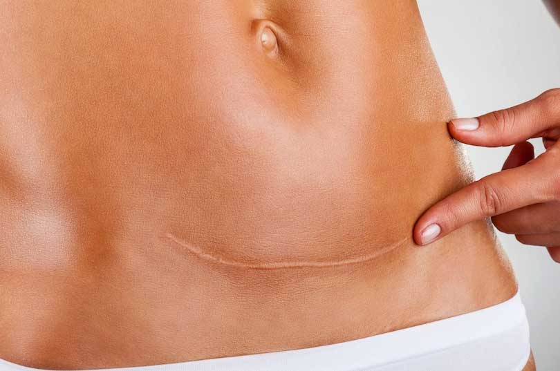 Καισαρική και Κίνδυνος Παχυσαρκίας