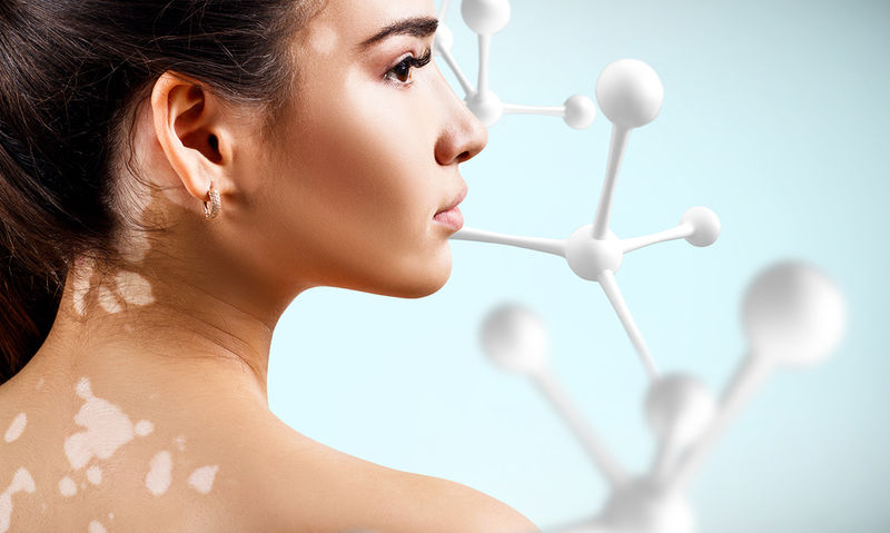 Λεύκη - Μία Παρεξηγημένη Ασθένεια