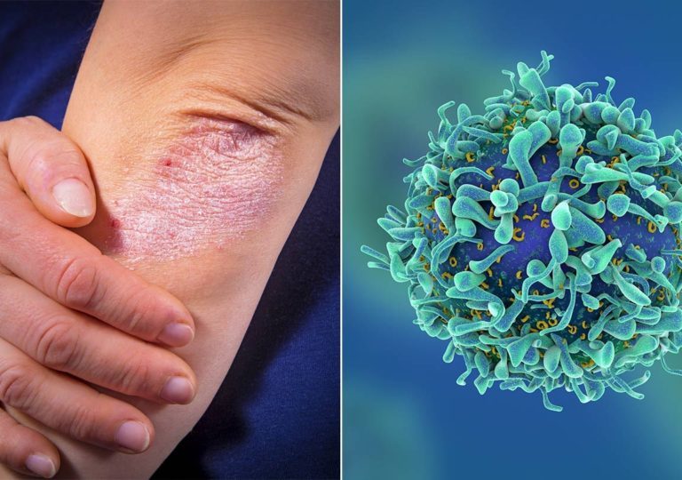 C-Derm Kρέμα Mουρουνέλαιου 50% - Αποτελεσματική και Ασφαλής στην Ψωρίαση κατά Πλάκας