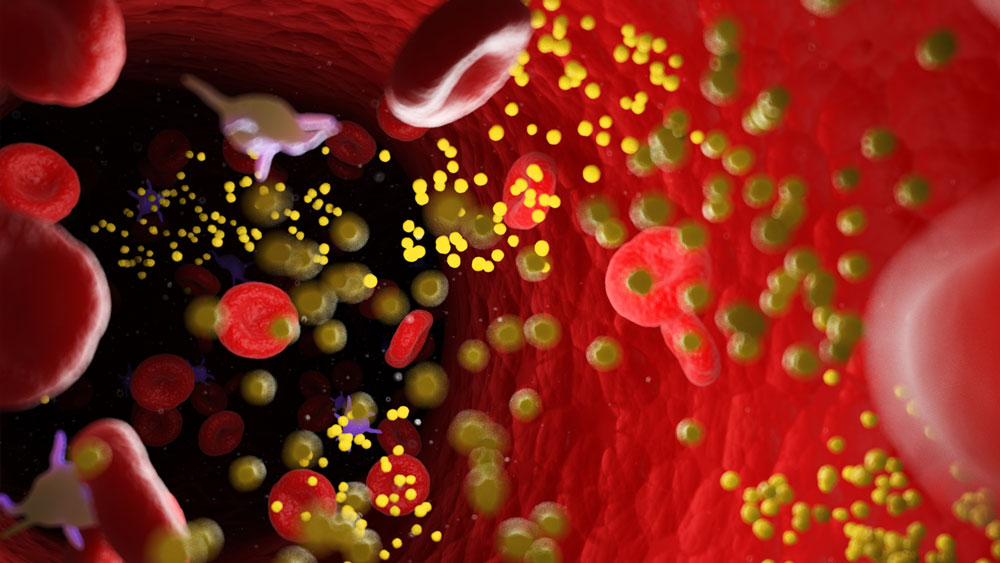 Μία ενέσιμη θεραπεία για την «κακή» χοληστερόλη πρόκειται να δοκιμαστεί μέσα στο 2020 στη Μεγάλη Βρετανία.