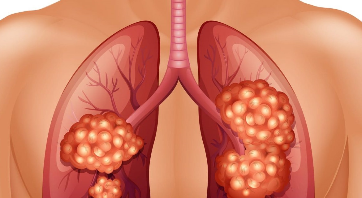 Ο καπνός του τσιγάρου περιέχει χιλιάδες, επιβλαβείς χημικές ενώσεις, οι οποίες μεταλλάσσουν το DNA των κυττάρων στους πνεύμονες και τα μετατρέπουν από υγιή σε καρκινικά.