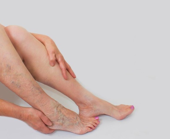 Το 60% των γυναικών παραπονιέται για βάρος των ποδιών και πρήξιμο, ενώ το ποσοστό των ανδρών είναι μικρότερο.