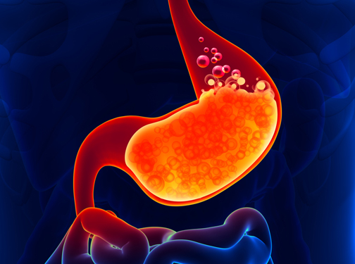 Η Γαστροοισοφαγική Παλινδρόμηση