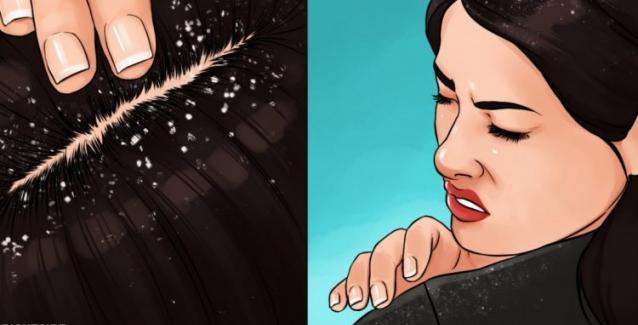 Όταν η Πιτυρίδα Επιμένει.