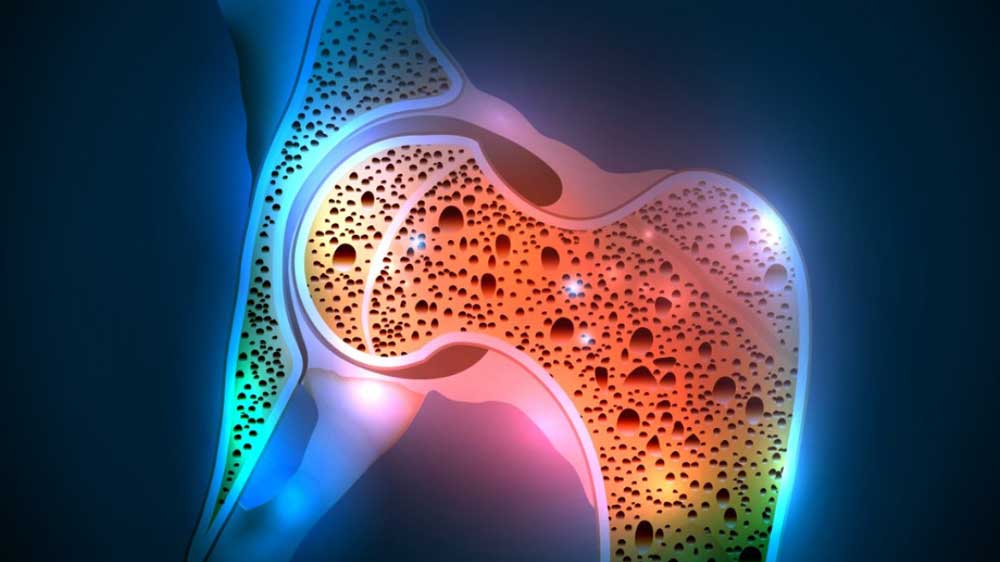 Οστεοπόρωση - Πρόληψη και Θεραπεία.