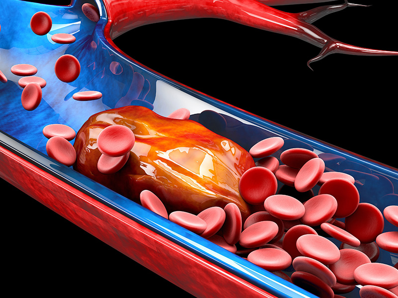 Αυξημένος Κίνδυνος Θρομβοεμβολικής Νόσου και Σχετιζόμενης Θνησιμότητας σε Ασθενείς με COVID-19.