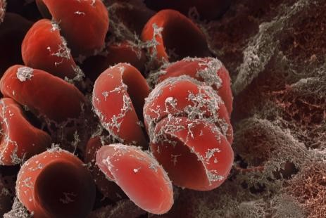 Μετά την Άτυπη Θρόμβωση, το Σύνδρομο Τριχοειδούς Διαρροής;