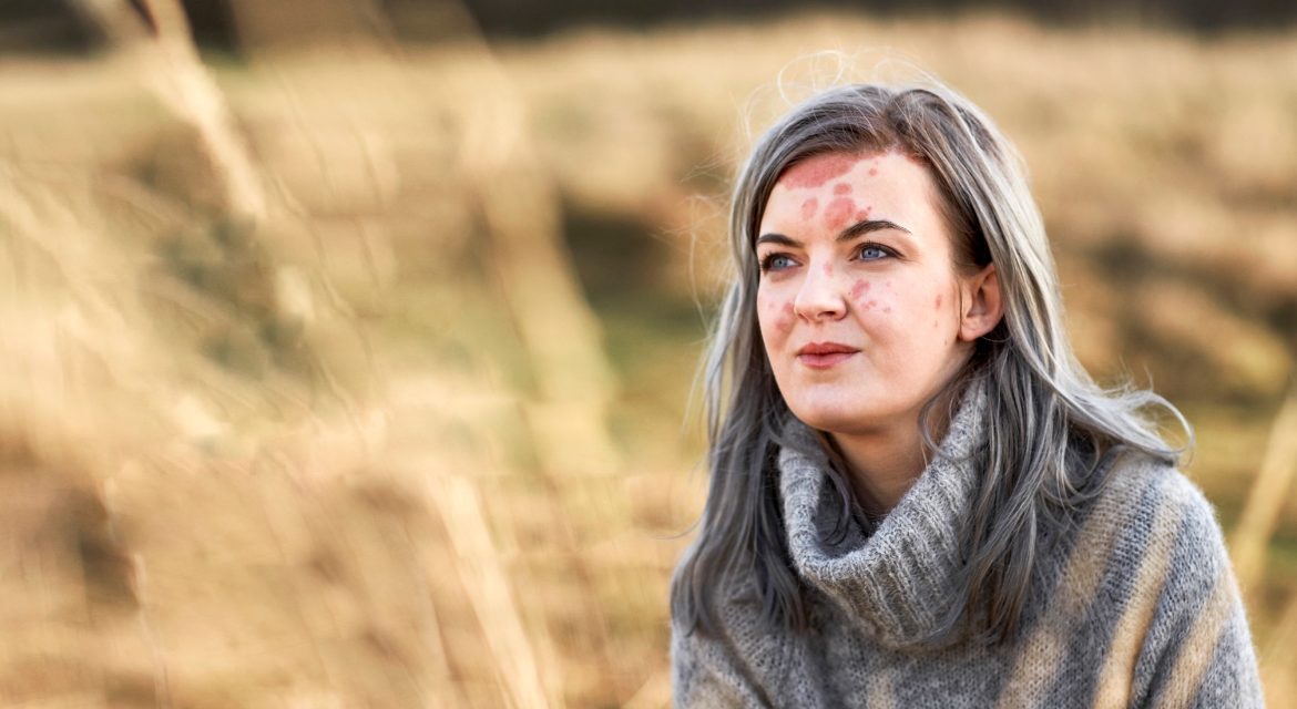 Είναι Εφικτή η Απομάκρυνση των Εξάρσεων σε Ασθενείς με κατά Πλάκας Ψωρίαση;