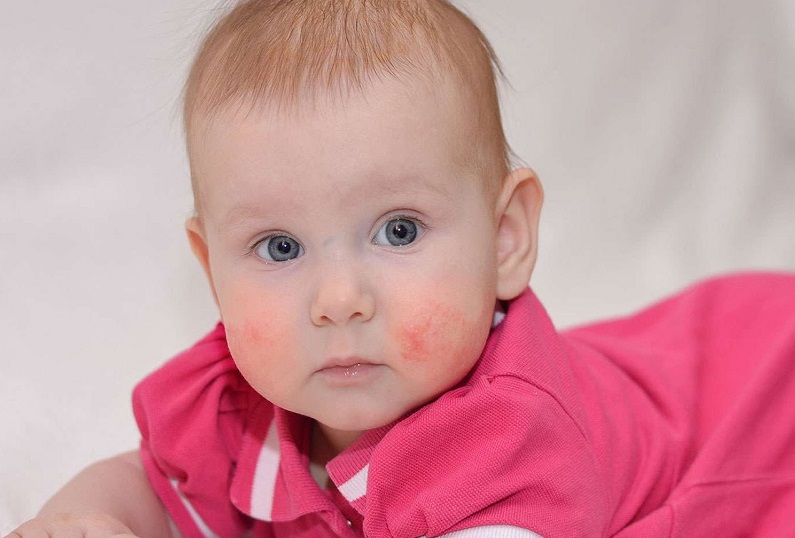 Συχνά Προβλήματα του Βρεφικού Δέρματος.