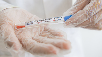 Επιστολή Σ. Κυριακίδου προς τους Υπουργούς Υγείας της ΕΕ για την Ευλογιά των Πιθήκων.