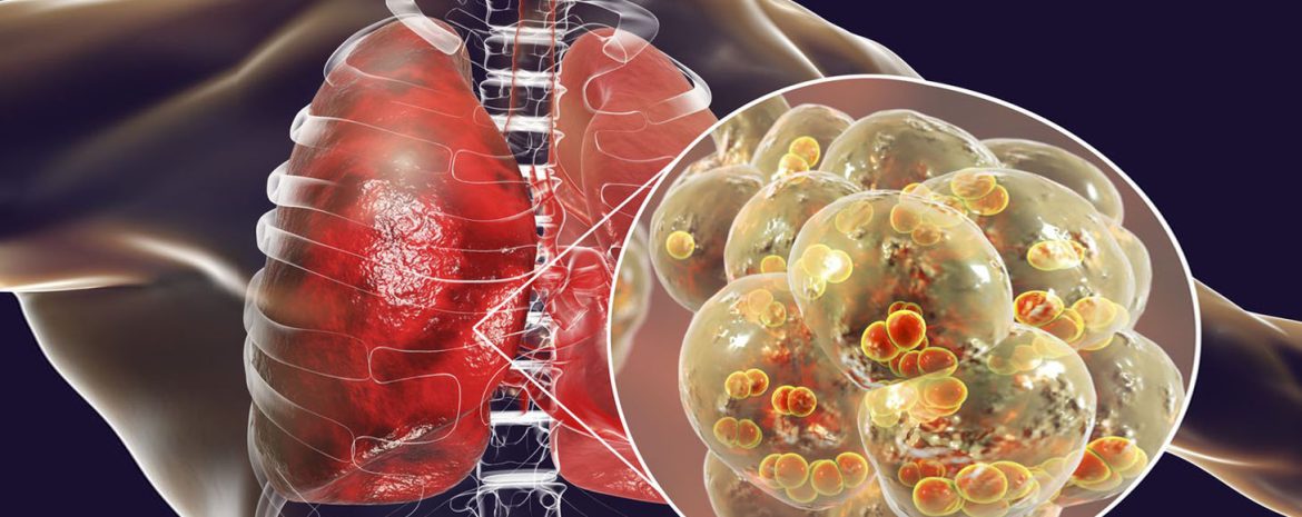 Βρογχιολίτιδα σε Ηλικιωμένους: Ένα Εμβόλιο 84% Αποτελεσματικό