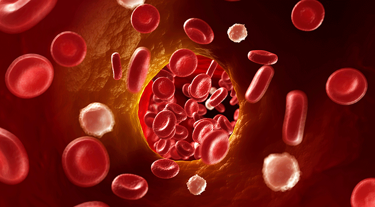 Θρομβοφλεβίτιδα (ή φλεβική θρόμβωση) είναι μια φλεγμονή του βλεννογόνου της φλέβας λόγω της παρουσίας ενός θρόμβου αίματος.