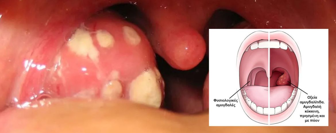 Πυογόνος Στρεπτόκοκκος: από τη Φαρυγγοαμυγδαλίτιδα έως τις Διεισδυτικές Λοιμώξεις