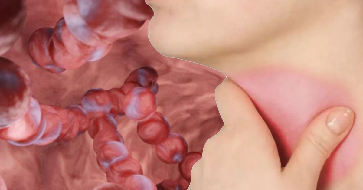 Πυογόνος Στρεπτόκοκκος: από τη Φαρυγγοαμυγδαλίτιδα έως τις Διεισδυτικές Λοιμώξεις Πυογόνος Στρεπτόκοκκος: από τη Φαρυγγοαμυγδαλίτιδα έως τις Διεισδυτικές Λοιμώξεις