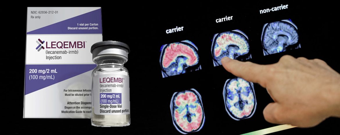 ΗΠΑ: Νέα Θεραπεία κατά του Αλτσχάιμερ