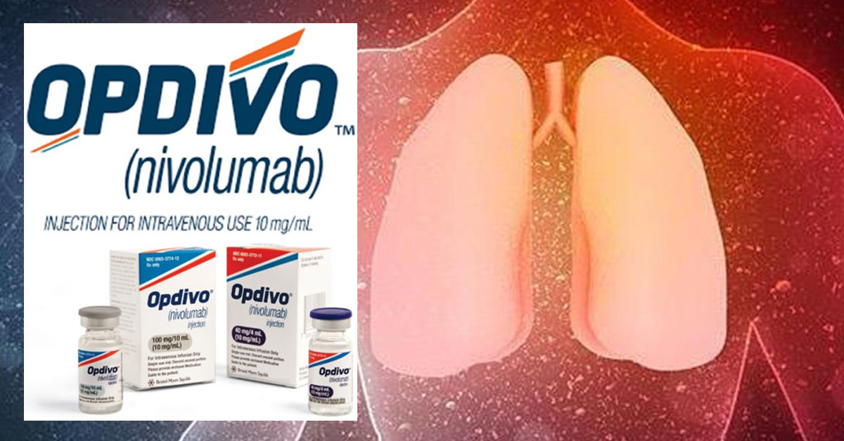 Έγκριση Συνδυασμού Nivolumab με Χημειοθεραπεία με Βάση την Πλατίνα για τον Χειρουργίσιμο Καρκίνο του Πνεύμονα