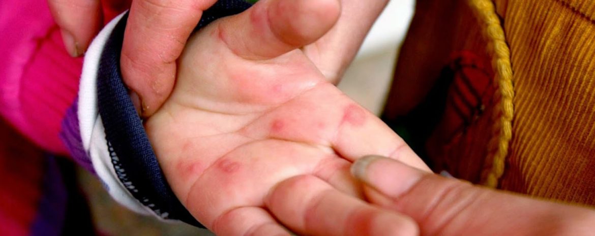 Κρούσματα Κοξάκι σε 41 παιδιά στη Λάρισα χωρίς επιπλοκές