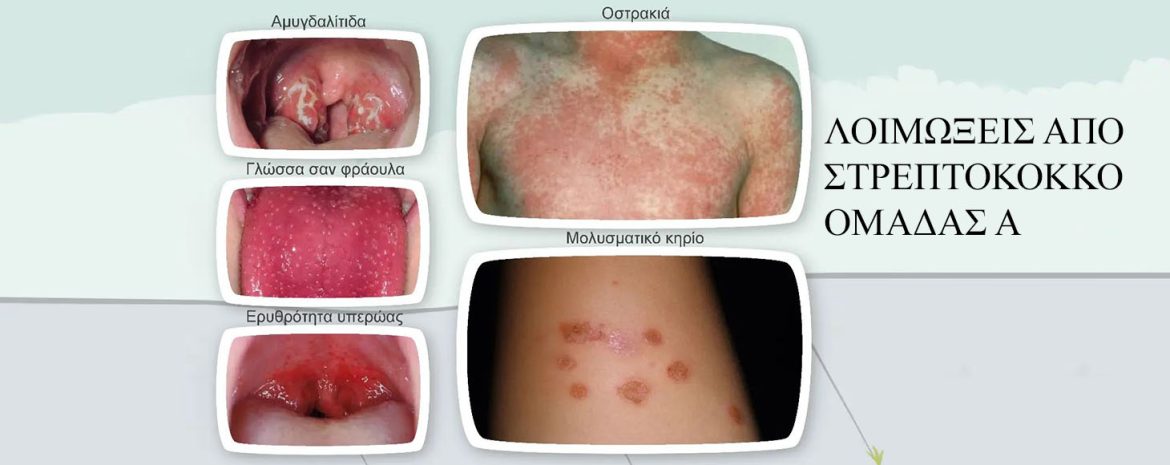 Στρεπτόκοκκος ομάδας Α ή πυογόνος στρεπτόκοκκος ένα βακτήριο που προκαλεί τόσο ήπιες όσο και σοβαρές λοιμώξεις στον άνθρωπο