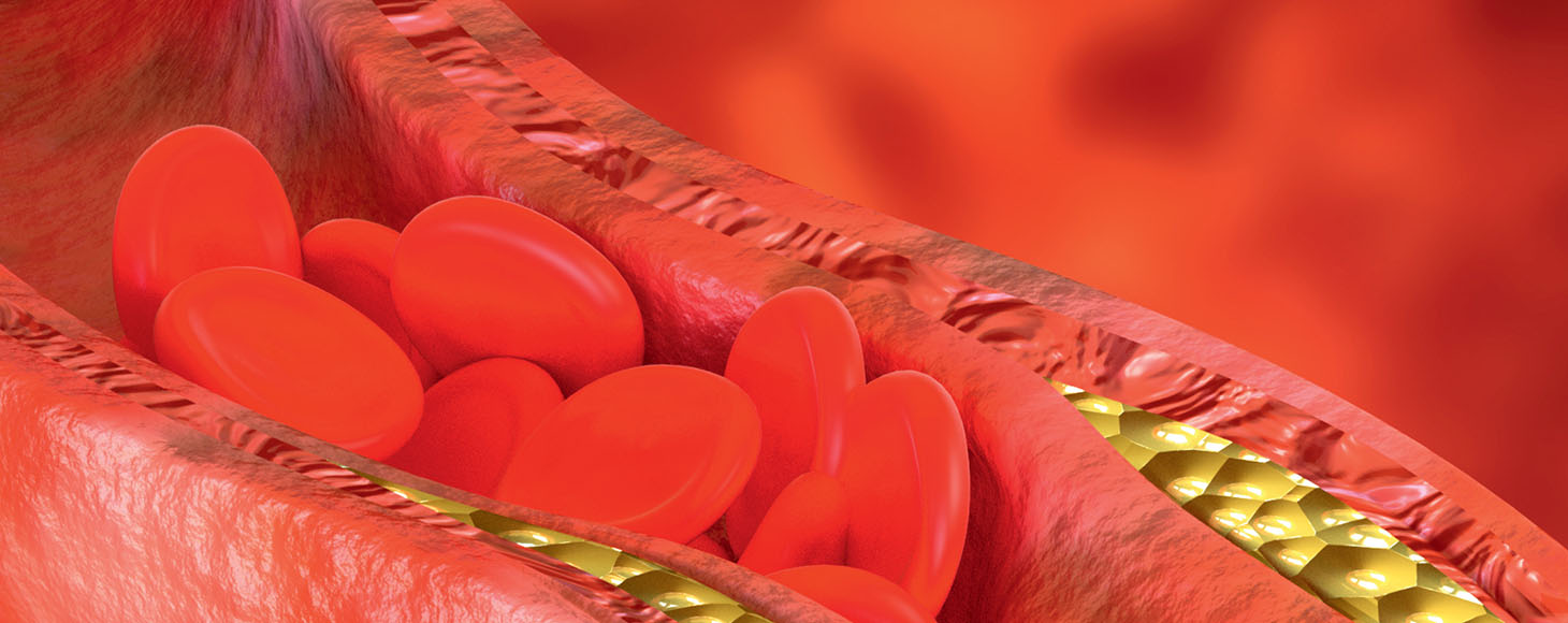 Επτά Ερωτήσεις Σχετικά με τη Δυσλιπιδαιμία