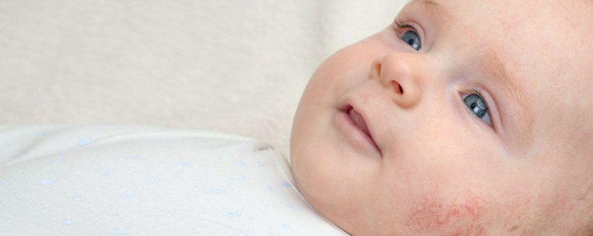 Τα εξανθήματα στα βρέφη μπορεί να προκληθούν από την πάνα, την ηλικία αλλά και από ιογενείς λοιμώξεις