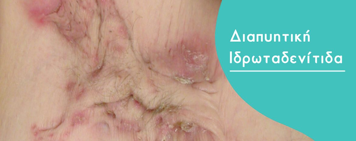 Έγκριση Μπιμεκιζουμάμπης από ΕΕ ως Βιολογικός Παράγοντας για Διαπυητική Ιδρωταδενίτιδα